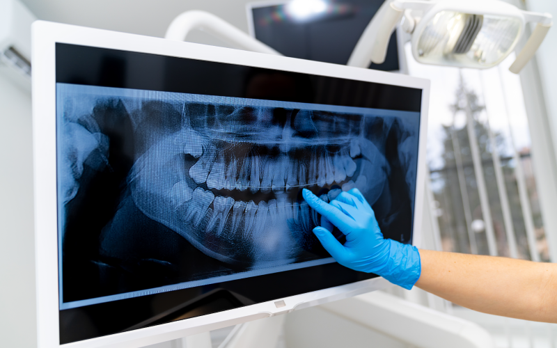 Revisions X-rays 
